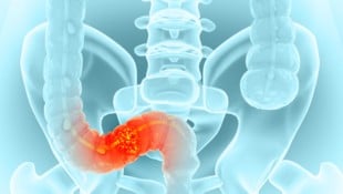 Darmgewächse früh entfernen, damit kein Krebs entsteht.