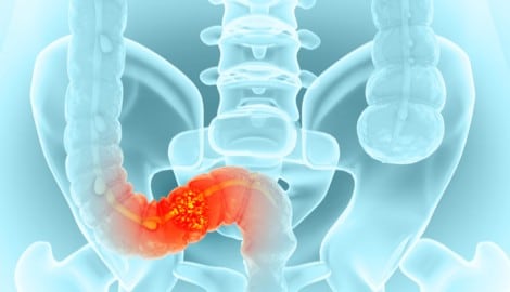 Darmgewächse früh entfernen, damit kein Krebs entsteht.