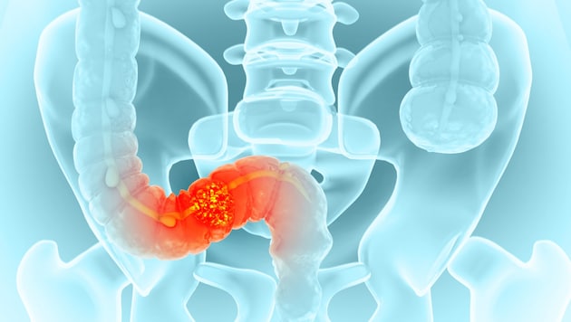 Darmgewächse früh entfernen, damit kein Krebs entsteht.