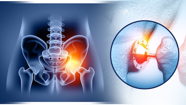 Selbst harmlos scheinende Infektionen können bei künstlichen Gelenken zum Problem werden.