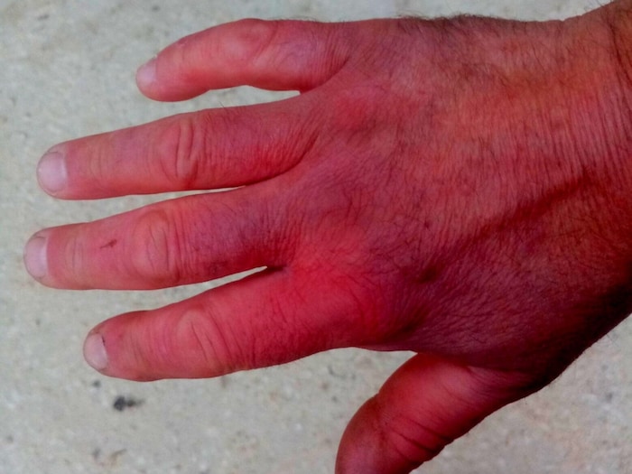 Dunkle Färbungen seiner Hand durch Gebirgsfrost