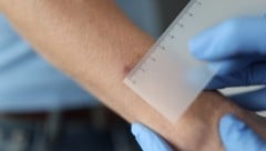 Die Entfernung eines Hauttumors ist in Wien eine Kassenleistung, in der Steiermark jedoch nicht ...