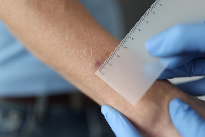 Die Entfernung eines Hauttumors ist in Wien eine Kassenleistung, in der Steiermark jedoch nicht ...