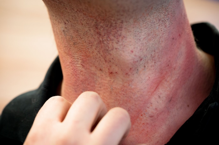 Ausgeprägte Hautrötungen sind ein Anzeichen für eine schlimmere allergische Reaktion.