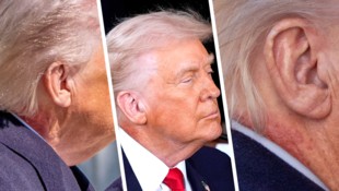 US-Präsident Donald Trump überrascht neuerdings mit einem roten Ausschlag am Hals. 