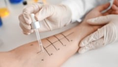 Mittels Prick-Test die Allergie austesten lassen!