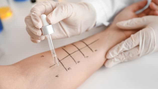 Mittels Prick-Test die Allergie austesten lassen!