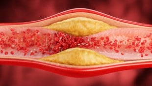Ablagerungen in den Gefäßen schaden mitunter dem Herz.