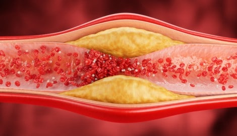 Ablagerungen in den Gefäßen schaden mitunter dem Herz.