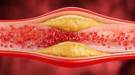 Ablagerungen in den Gefäßen schaden mitunter dem Herz.