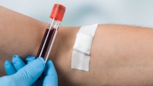 Früherkennung von Darmkrebs aus dem Blut nach weltweit neuesten wissenschaftlichen Standards ...