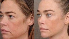 Denise Richards hat vor einigen Monaten ein komplettes Facelifting machen lassen. Das Ergebnis ...