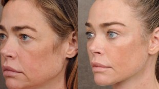 Denise Richards hat vor einigen Monaten ein komplettes Facelifting machen lassen. Das Ergebnis ...