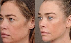 Denise Richards hat vor einigen Monaten ein komplettes Facelifting machen lassen. Das Ergebnis ...