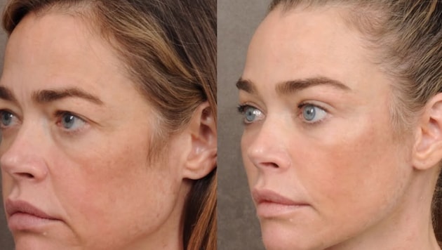 Denise Richards hat vor einigen Monaten ein komplettes Facelifting machen lassen. Das Ergebnis ...