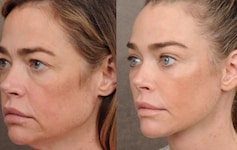 Denise Richards hat vor einigen Monaten ein komplettes Facelifting machen lassen. Das Ergebnis ...