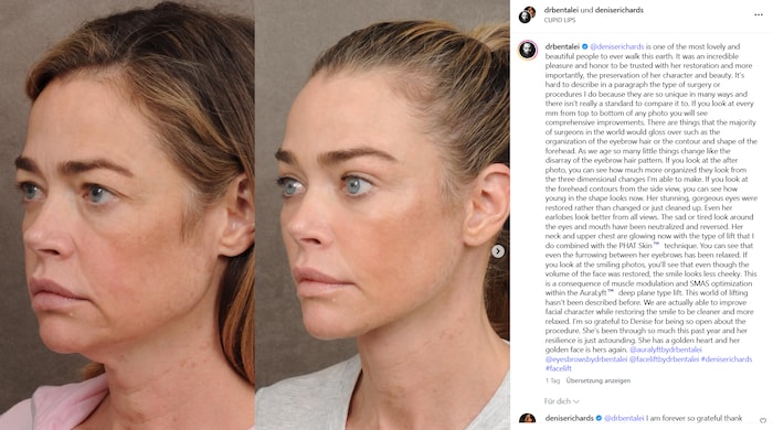 Denise Richards postete auf Instagram Fotos ihres Faceliftings und begeisterte mit ihrer ...