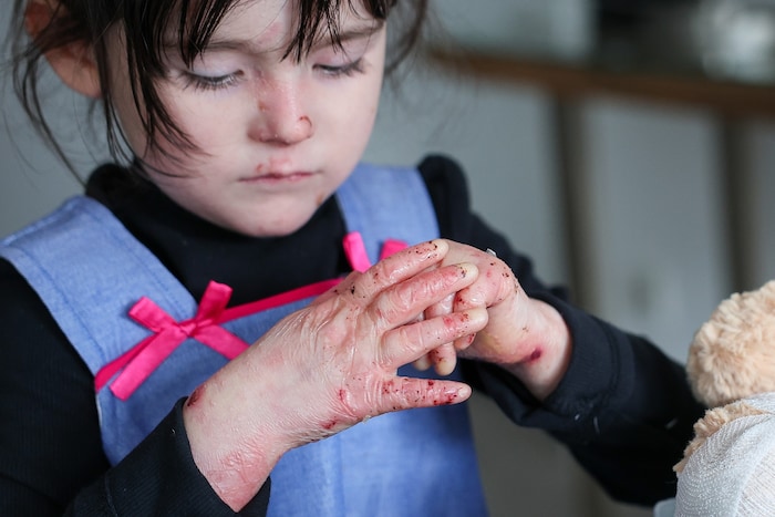 Geringste Berührungen lösen Blasen und Wunden aus