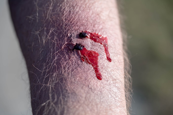 Unabhängig von der Größe ist bei einer Bissverletzung immer Vorsicht geboten.