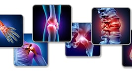 Die Gelenke entzünden sich bei aktivierter Arthrose.