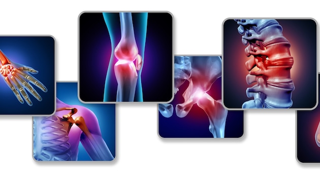 Die Gelenke entzünden sich bei aktivierter Arthrose.