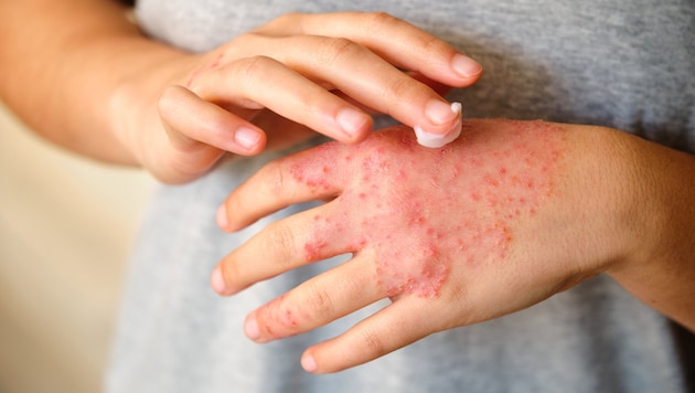 Hände, Ellenbeugen, Kniekehlen, Nacken und das Gesicht (Augenlider) sind die häufigsten ...