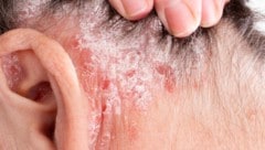 Psoriasis: Befallene Stellen könnten krebsfrei bleiben. 