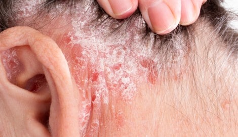 Psoriasis: Befallene Stellen könnten krebsfrei bleiben. 
