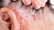 Psoriasis: Befallene Stellen könnten krebsfrei bleiben. 