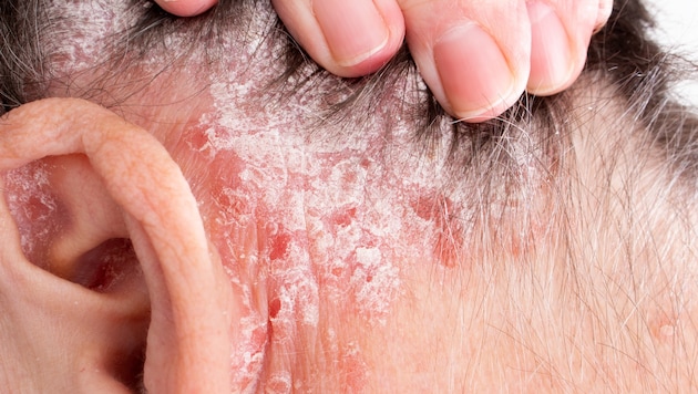 Psoriasis: Befallene Stellen könnten krebsfrei bleiben.
