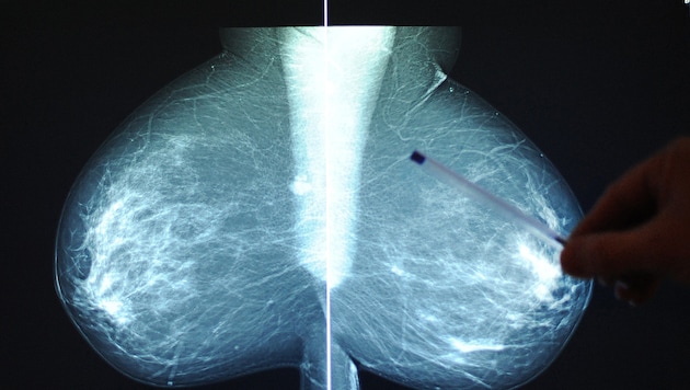 Aufnahmen des Brustgewebes können auch Rückschlüsse auf die Arterienbeschaffenheit bringen.