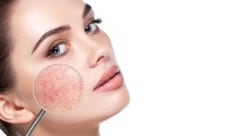 Geplatzte Äderchen (Couperose) gelten als Vorstufe von Rosacea. Viele Menschen wissen nicht, ...