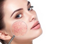 Geplatzte Äderchen (Couperose) gelten als Vorstufe von Rosacea. Viele Menschen wissen nicht, ...