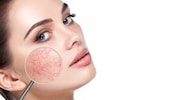 Geplatzte Äderchen (Couperose) gelten als Vorstufe von Rosacea. Viele Menschen wissen nicht, ...
