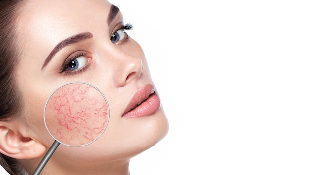 Geplatzte Äderchen (Couperose) gelten als Vorstufe von Rosacea. Viele Menschen wissen nicht, ...