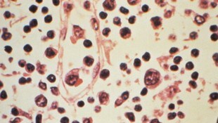 Im Vorjahr hat es in Österreich 32 Hantavirus-Infektionen gegeben.