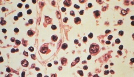 Im Vorjahr hat es in Österreich 32 Hantavirus-Infektionen gegeben.