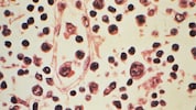 Im Vorjahr hat es in Österreich 32 Hantavirus-Infektionen gegeben.