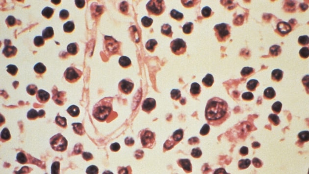 Im Vorjahr hat es in Österreich 32 Hantavirus-Infektionen gegeben.