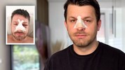 Timo Dutzler erlitt ein blaues Auge und einen Nasenbruch. Von den Tätern fehlt bisher aber ...