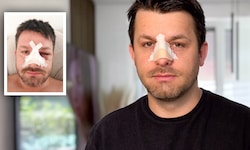 Timo Dutzler erlitt ein blaues Auge und einen Nasenbruch. Von den Tätern fehlt bisher aber ...