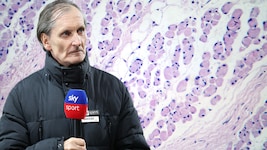 Alfred Tatar starb an ALS – siehe Darstellung oben unter dem Mikroskop: Muskelzellen, die von ...