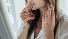 Patienten mit Psoriasisarthritis profitieren von der Kombitherapie.