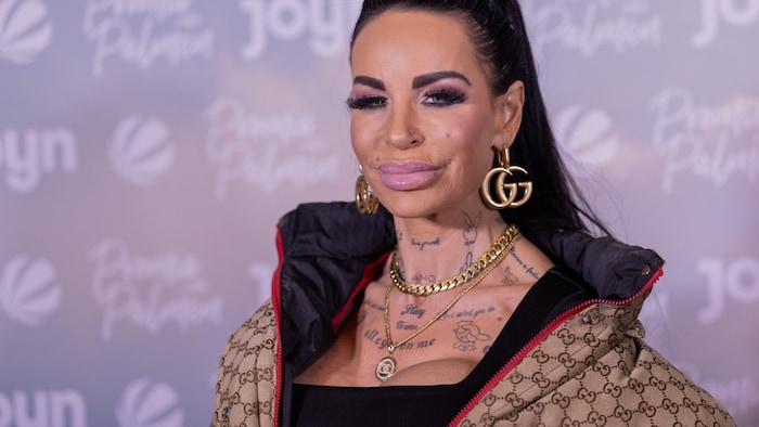 Gina-Lisa Lohfink kämpft mit den Folgen einer verpfuschten Po-OP aus der Türkei.