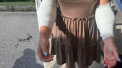 Die 27-Jährige erlitt Verletzungen an beiden Armen: „Ich kann aktuell nicht einmal selbst Zähne ...