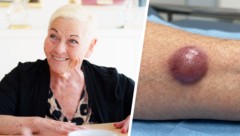 Das Merkelzellkarzinom beginnt als unscheinbarer Knoten, ist aber ein hochgefährlicher Tumor. ...