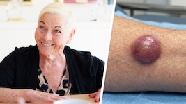 Das Merkelzellkarzinom beginnt als unscheinbarer Knoten, ist aber ein hochgefährlicher Tumor. ...