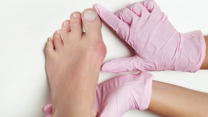 Die häufigste Fußfehlstellung ist ein Hallux valgus.