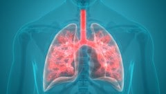 Interstitielle Lungenerkrankungen wie Lungenfibrose brauchen schnell Behandlung.