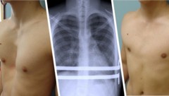 Links sieht man einen Patienten mit Trichterbrust vor, rechts nach erfolgreicher Behandlung.